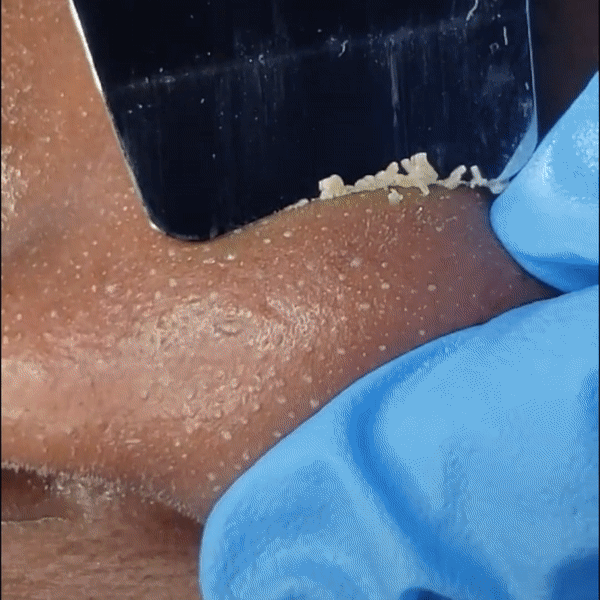 Skin Scrubber Ultrasonic