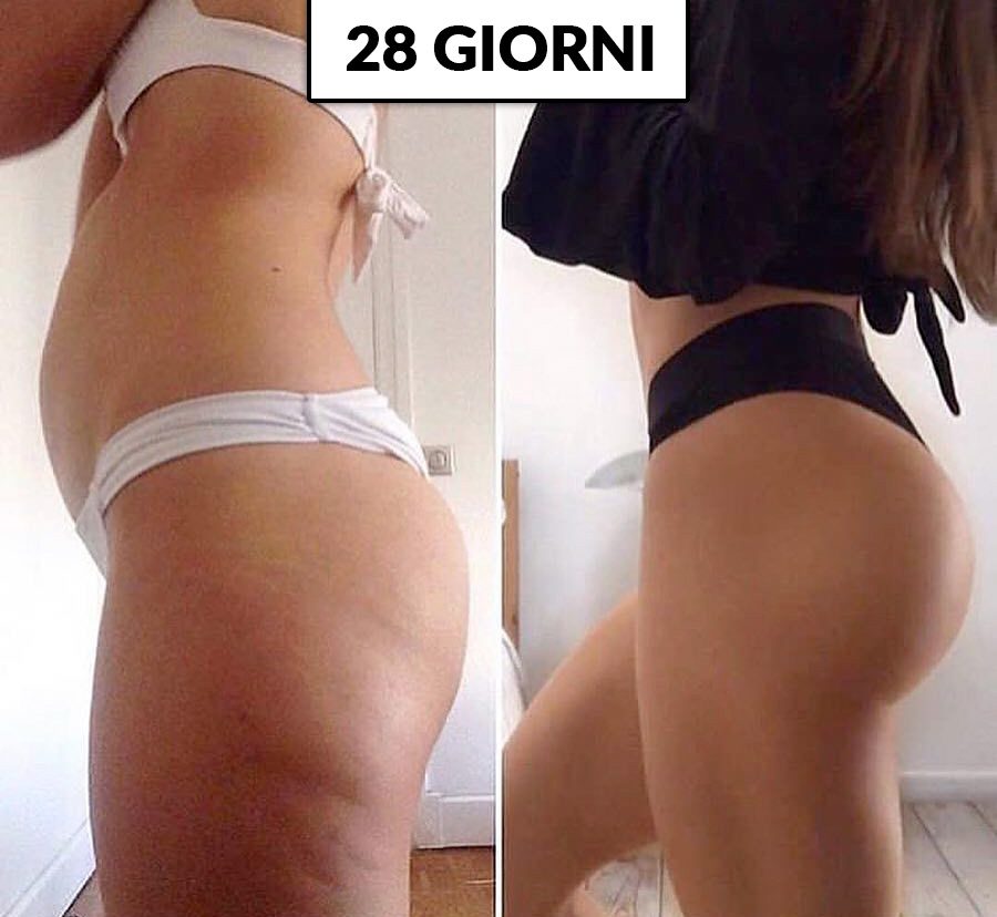 Liprox Dren come eliminare le smagliature e la cellulite