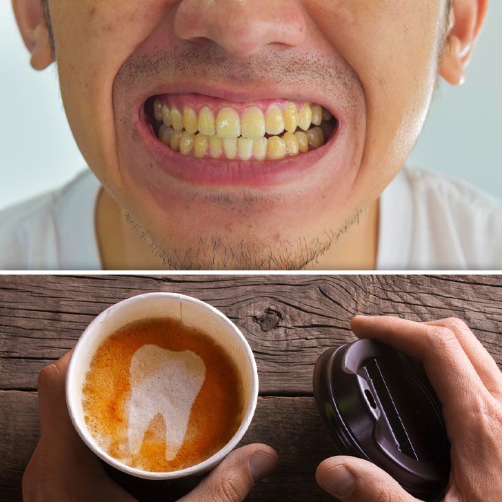 Instant Smile elimina le macchie sui denti