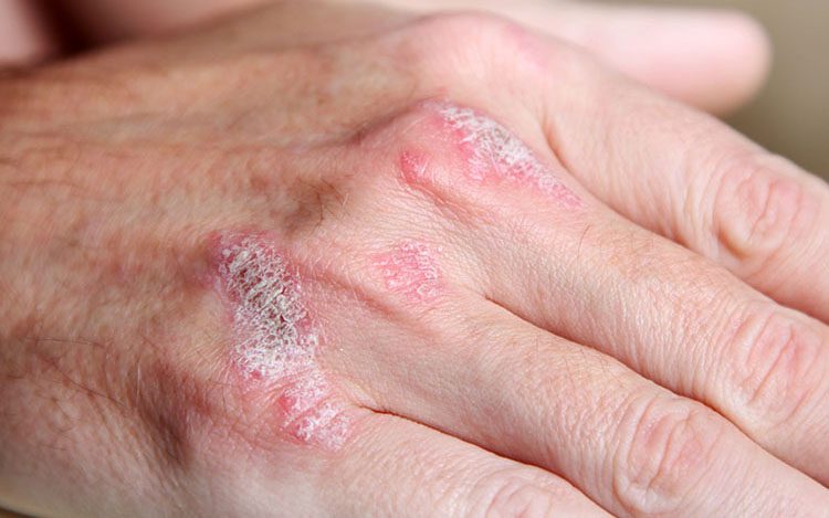 Come ridurre il prurito psoriasi psorisolv