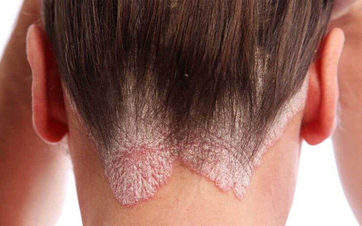 Psorisolv Shampoo Psoriasi