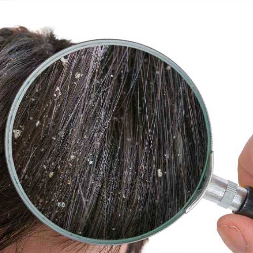 Psorisolv Shampoo Psoriasi prezzo