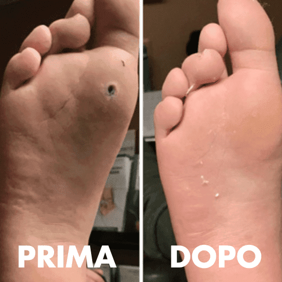 crema verrublock truffa rimuovere verruche rimedi