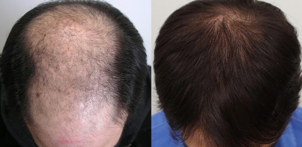 POOMP LOZIONE ANTICADUTA ricrescita capelli