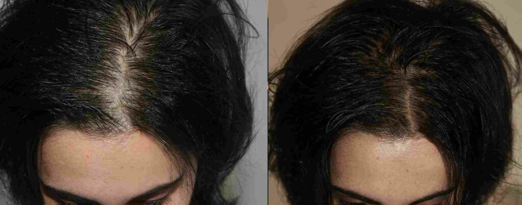 POOMP LOZIONE ANTICADUTA ricrescita capelli