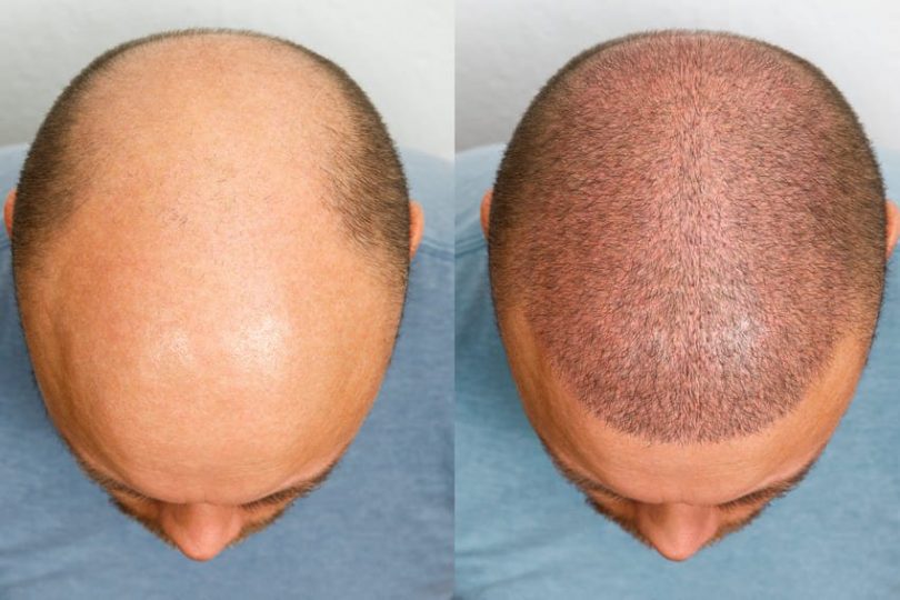 POOMP LOZIONE ANTICADUTA ricrescita capelli