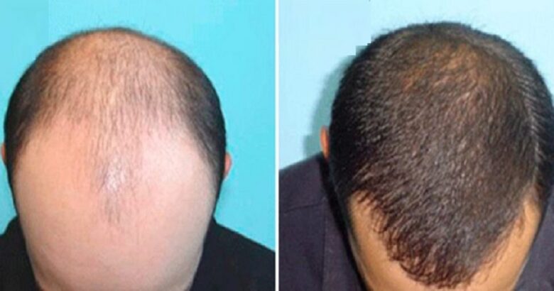 POOMP LOZIONE ANTICADUTA ricrescita capelli
